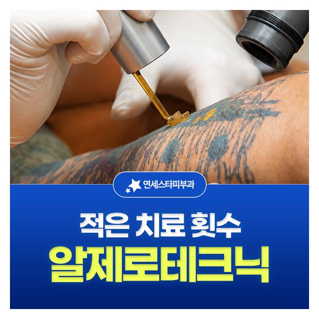 적은 치료 횟수 알제로테크닉 문신제거 효과는 빠르게