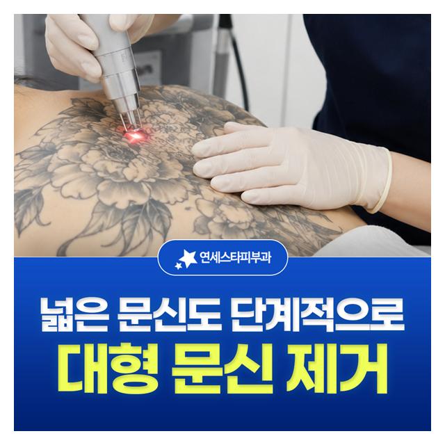 대형 문신 제거, 넓은 문신도 단계적으로 시술하여 제거합니다